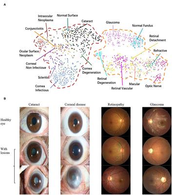 A Novel Hierarchical Deep Learning Framework for Diagnosing Multiple Visual Impairment Diseases in the Clinical Environment